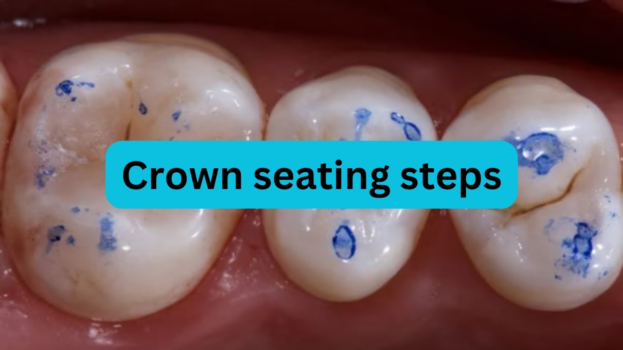 How to check crown seating?
