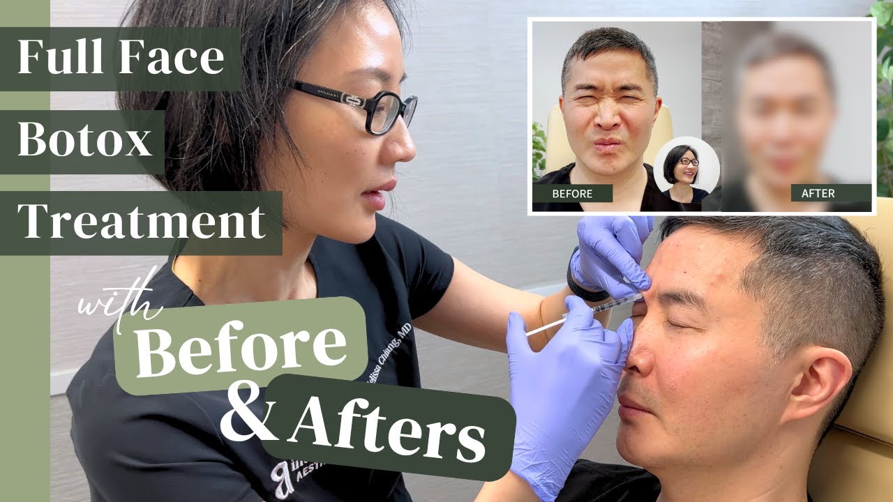 Is Full Face Botox Worth It? Before & After Results