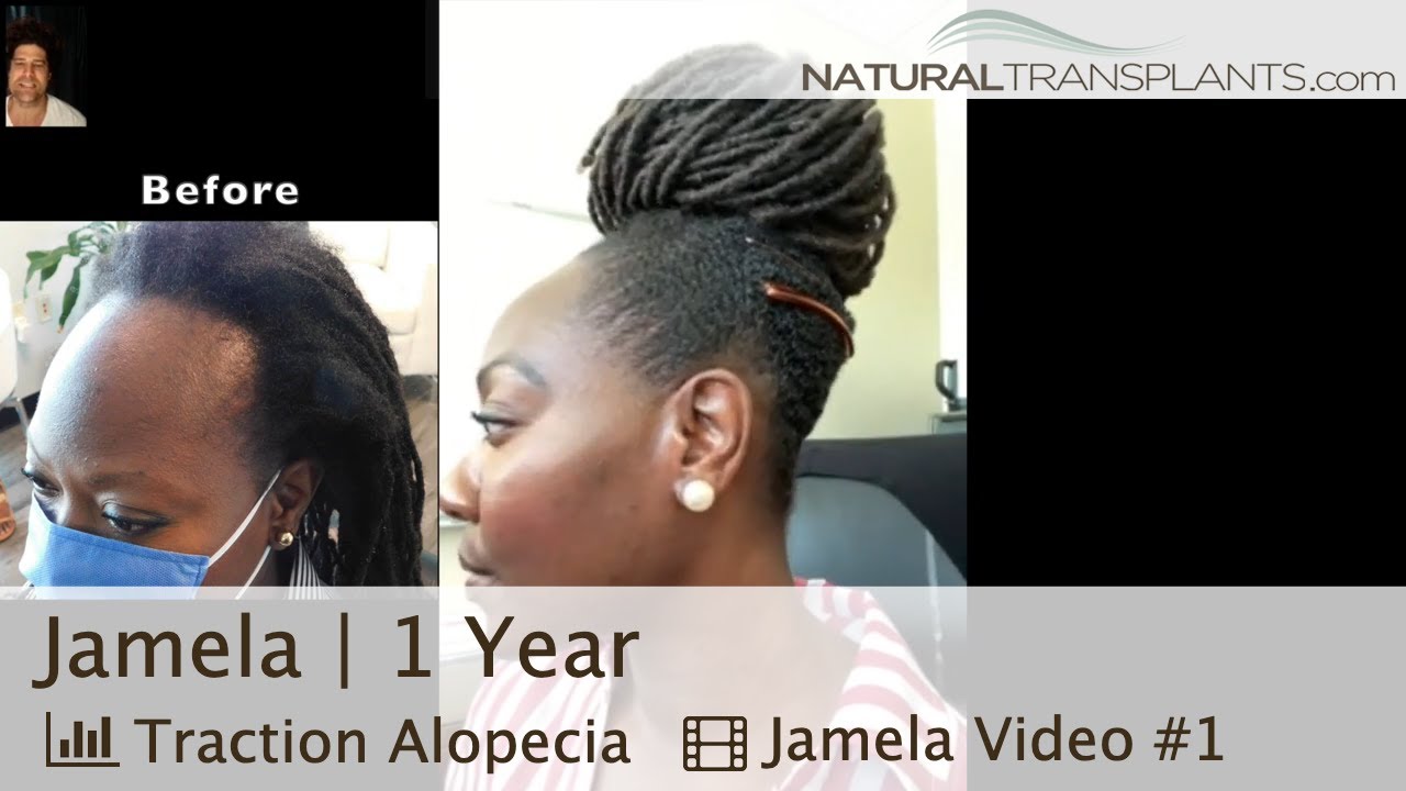 Hair Growth for Black Woman after Hair Transplant | Dr. Matt Huebner of Natural Transplants (Jamela)
