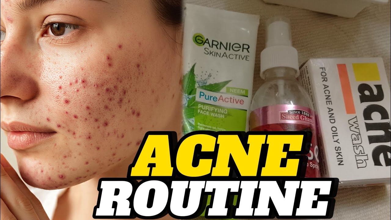 Simple Acne Routine | Acne Treatment at Home | Doorbeen