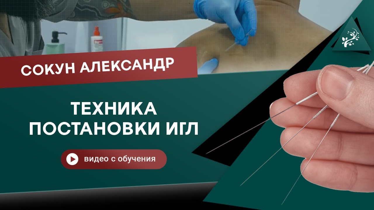 Как ставить иглы? Акупунктура. Метод сухой иглы. Сокун Александр