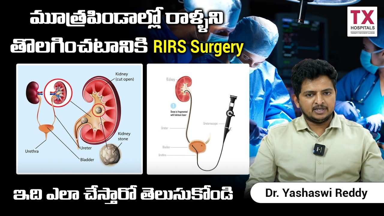మూత్రపిండాల్లో రాళ్ళకి RIRS Surgery || RIRS Surgery for Kidney Stone In Telugu || TX Hospitals