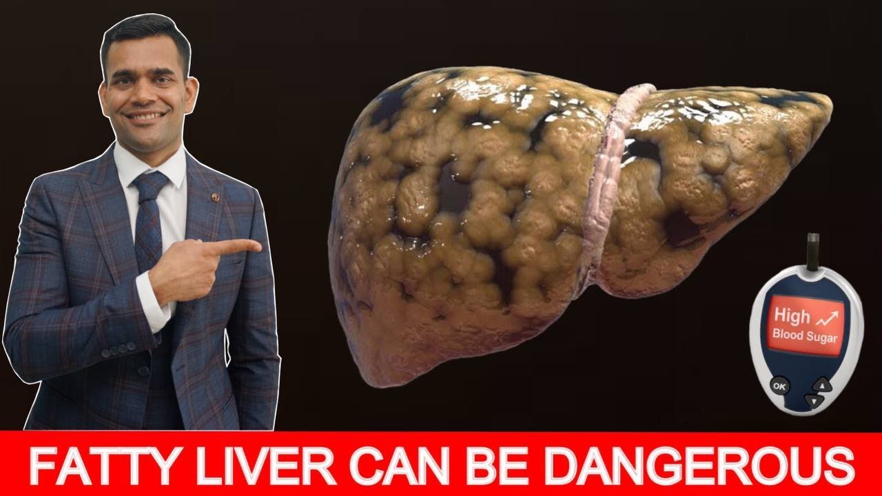 Fatty Liver Treatment | Fastest Way To Recover Fatty Liver  - Dr. Vivek Joshi