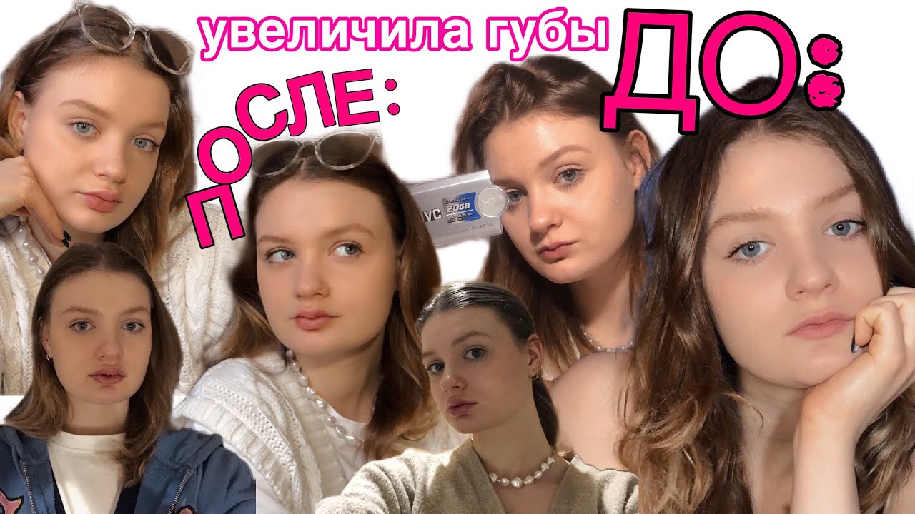 увеличила губы 👄 🎀 вЛоГ: моя «счастливая история».что нужно знать об увеличении губ