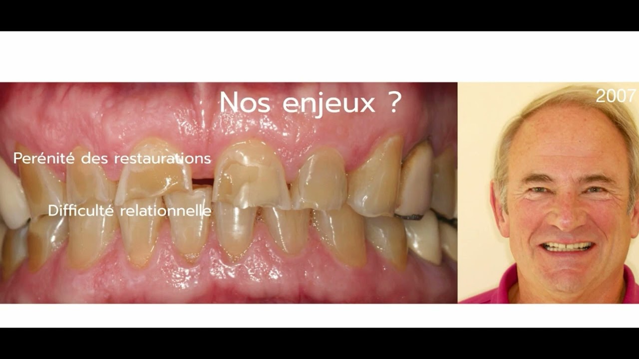 Extrait de la conférence « Reconstitutions des dents usées » du Dr Felenc