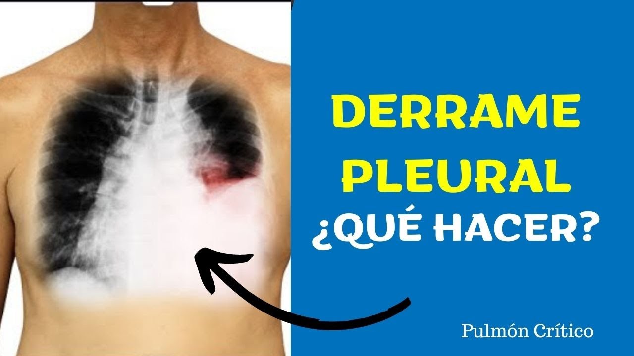 &iquest;Qu&eacute; hago si tengo derrame pleural?