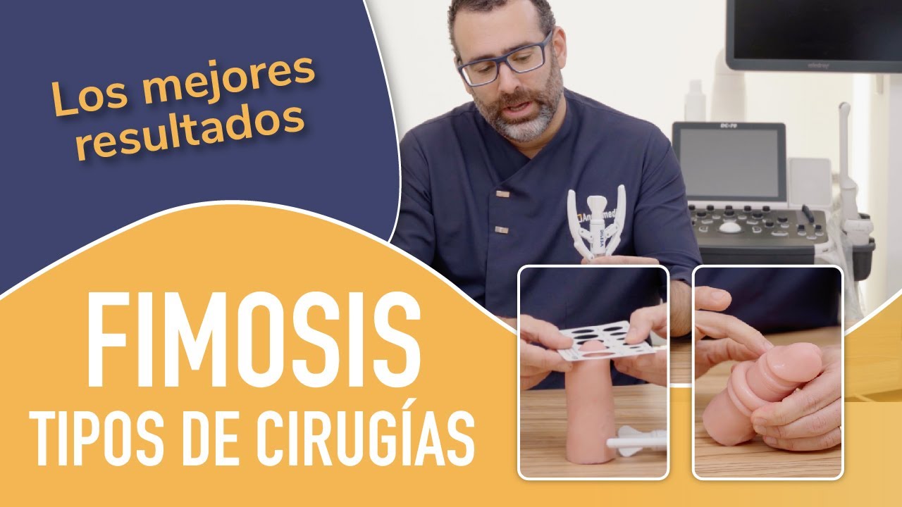 Tipos de Cirugías de Fimosis; Circuncisión clásica, con grapas o Prepucioplastia. Dr. García-Baquero