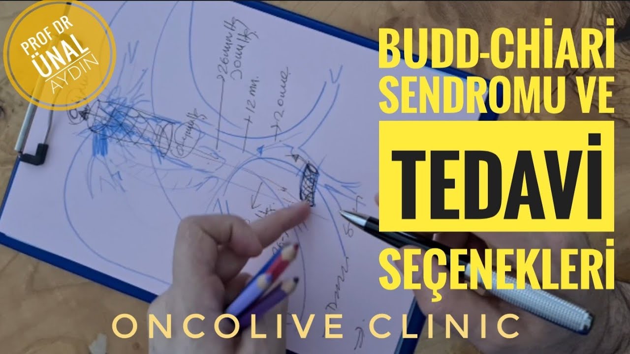 BUDD- CHIARI SENDROMU VE TEDAVİ SEÇENEKLERİ HASTA BRİFİNGİ @ProfDrUnalAydn