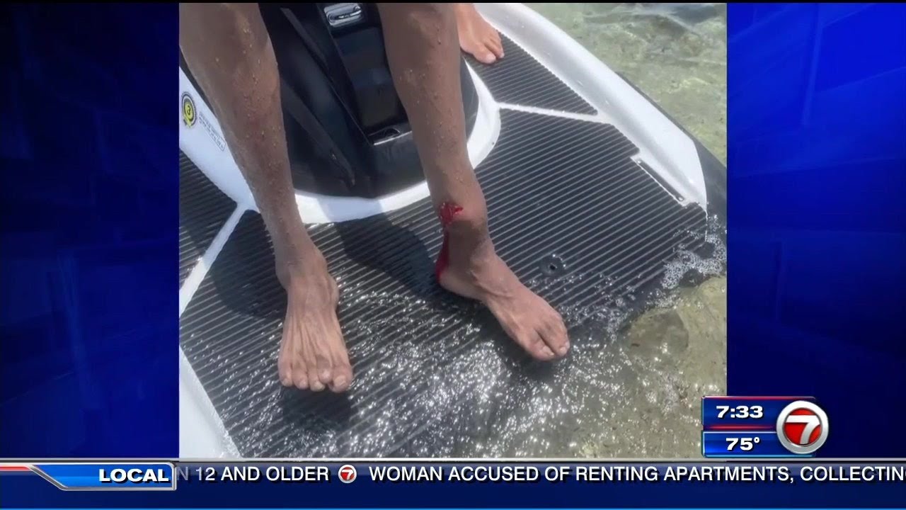 Wife: Husband suffers compound fracture after personal watercraft crash in Miami Beach