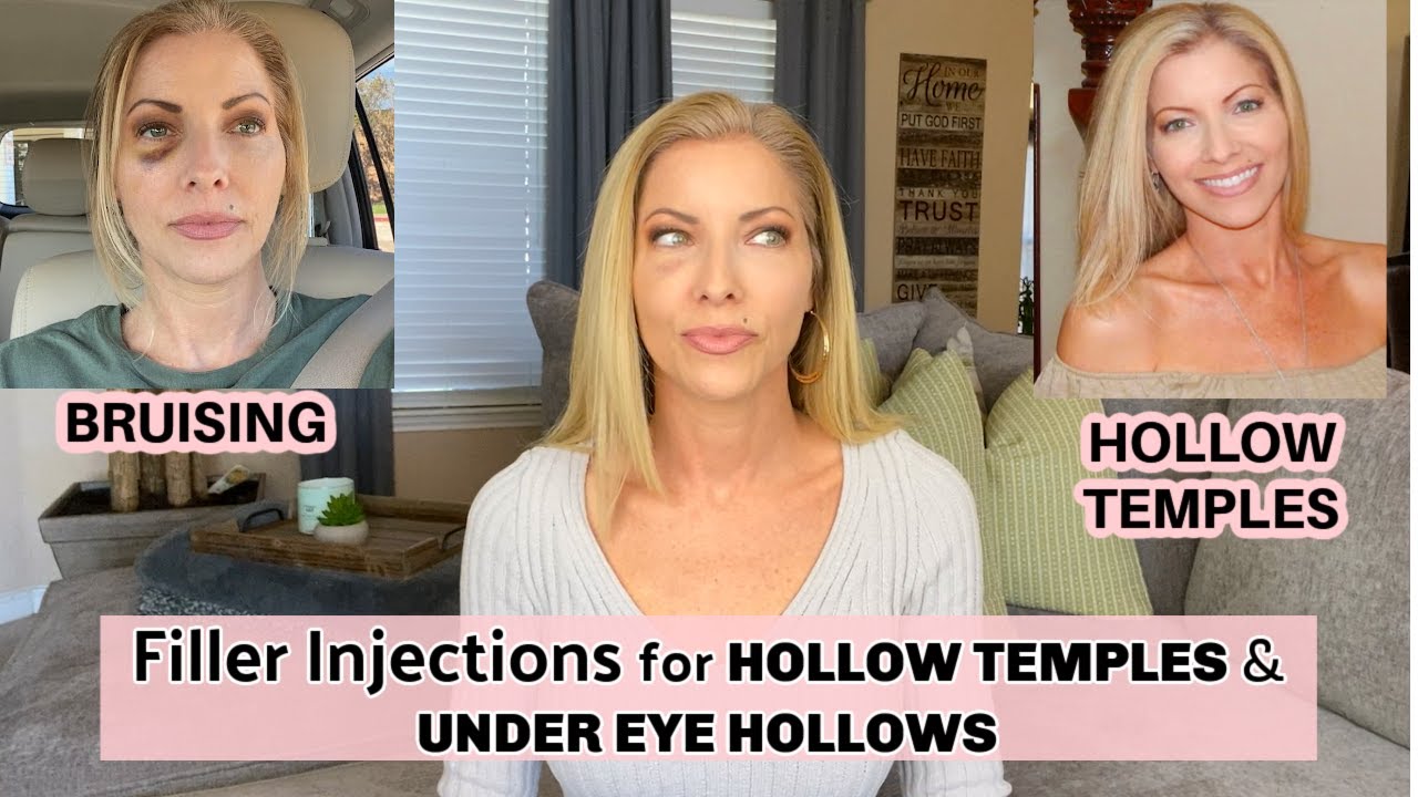 Temple & Under Eye Filler | Bruising and Lumps After Filler | What You Shoud Know | Look Younger!