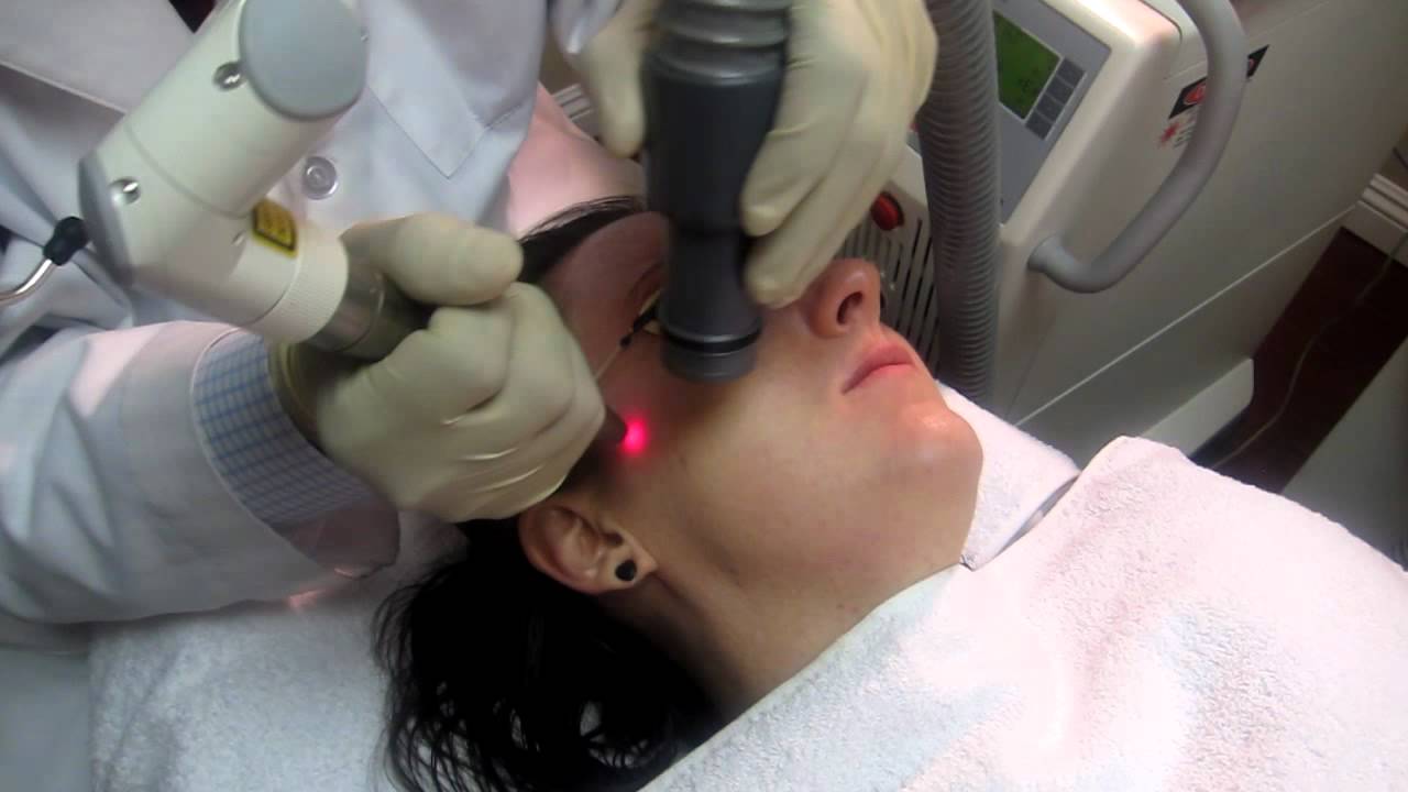 Micro Laser Peel- Fullerton-Irvine-Anaheim-Newport Beach-Long Beach-Cerritos-Pasadena-Corona
