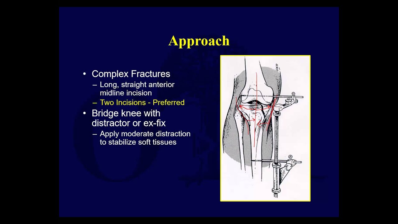 Переломы плато большеберцовой кости 1