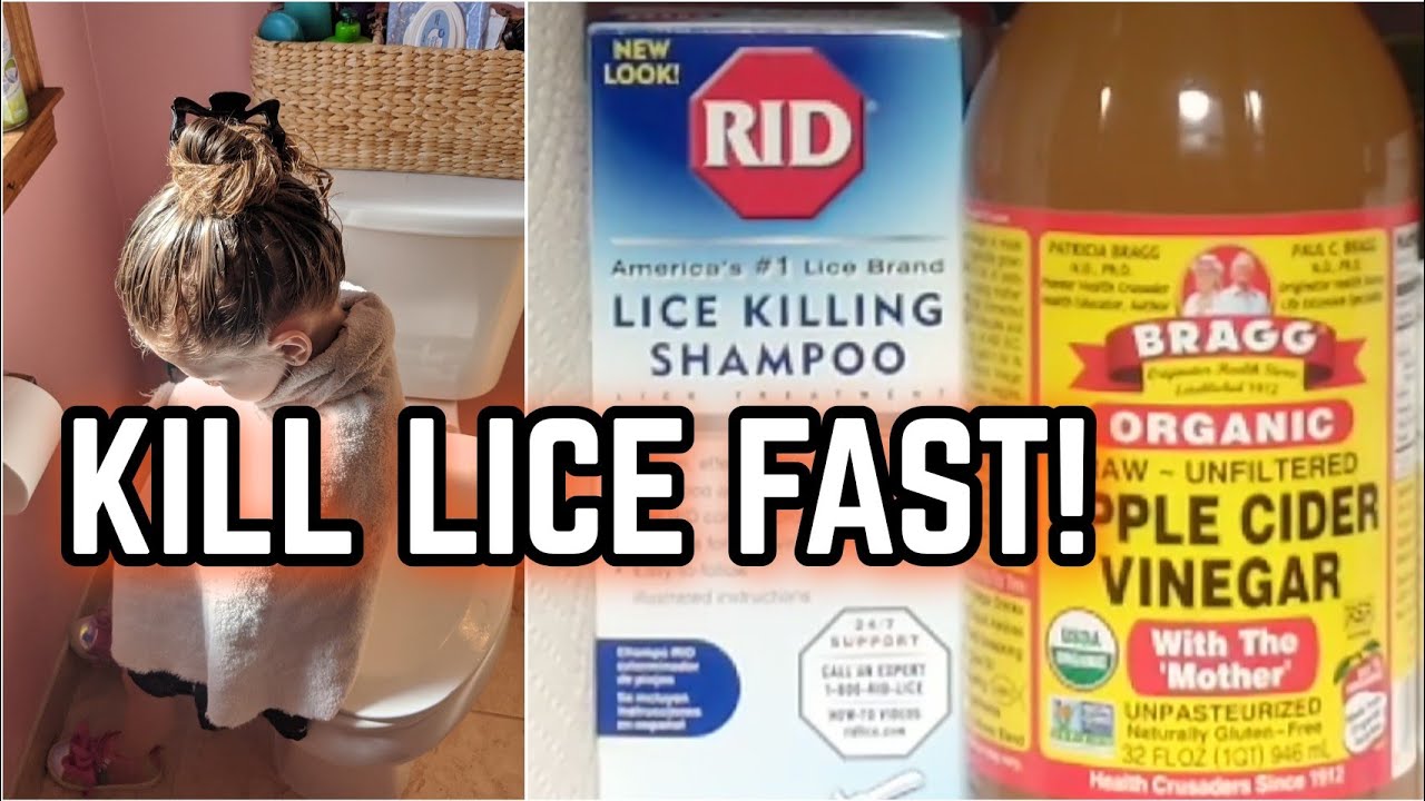 HOW TO GET RID OF LICE FAST!! 😲🦟 AND KEEP IT FROM COMING BACK!!