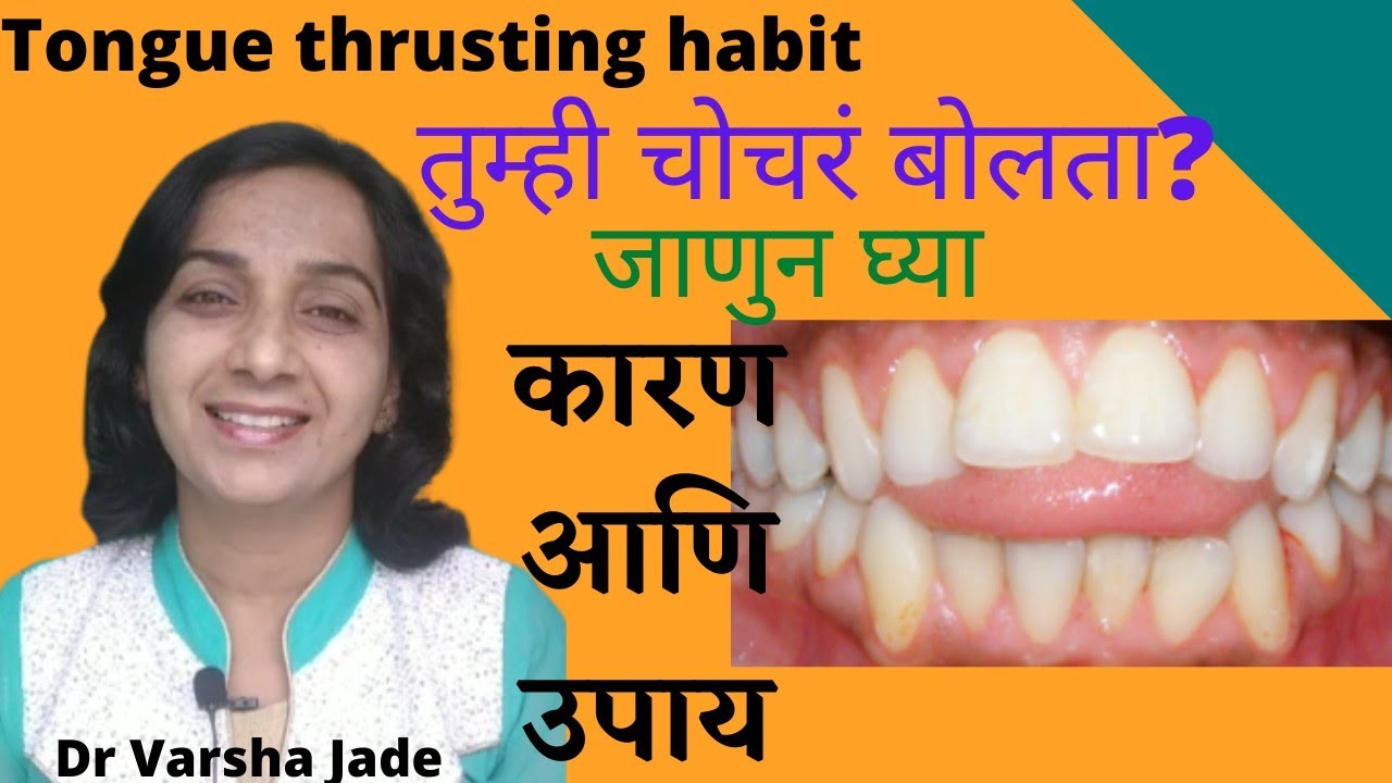 चोचरे/तोतरे बोलणे: कारण आणि उपाय|Tongue Thrusting Habit|जीभ जड असणे|बोलण्यातील दोष|दात पुढे असणे