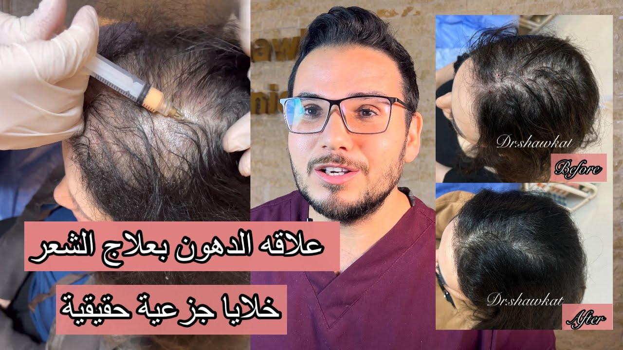 اقوي علاج بيطلع شعر :الخلايا الجزعيه الحقيقية لعلاج الشعر stem cells .