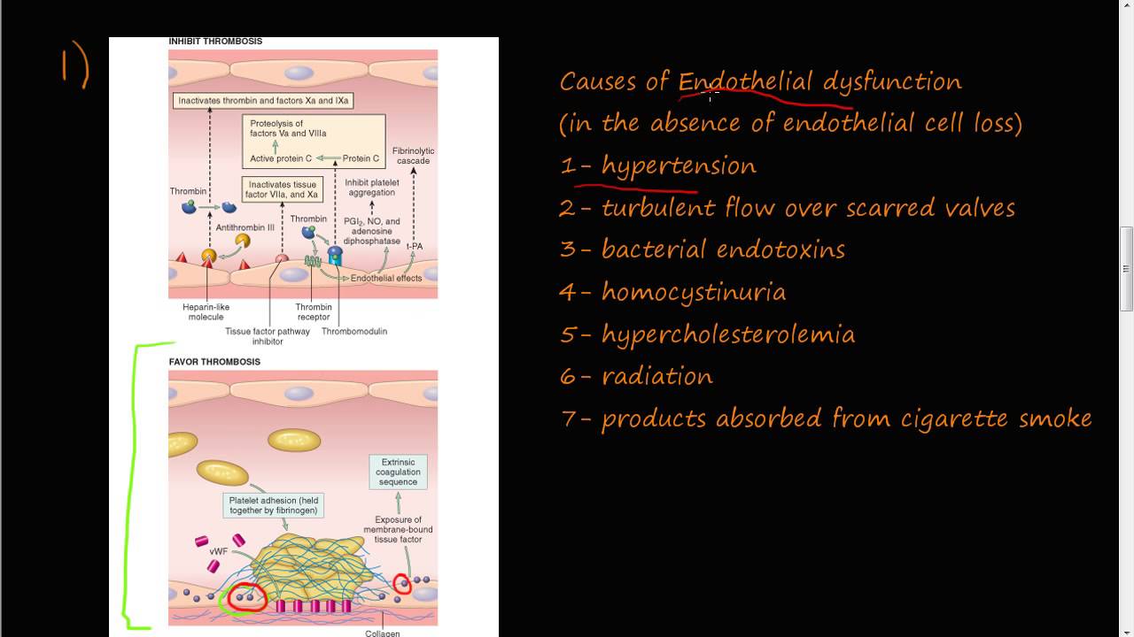 #53 - Thrombosis, Virchow's triad, Endothelial Injury