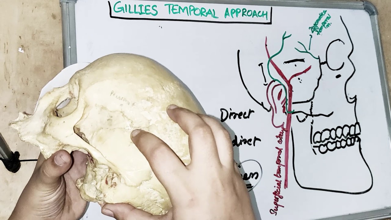 gillies temporal approach I dental lectures