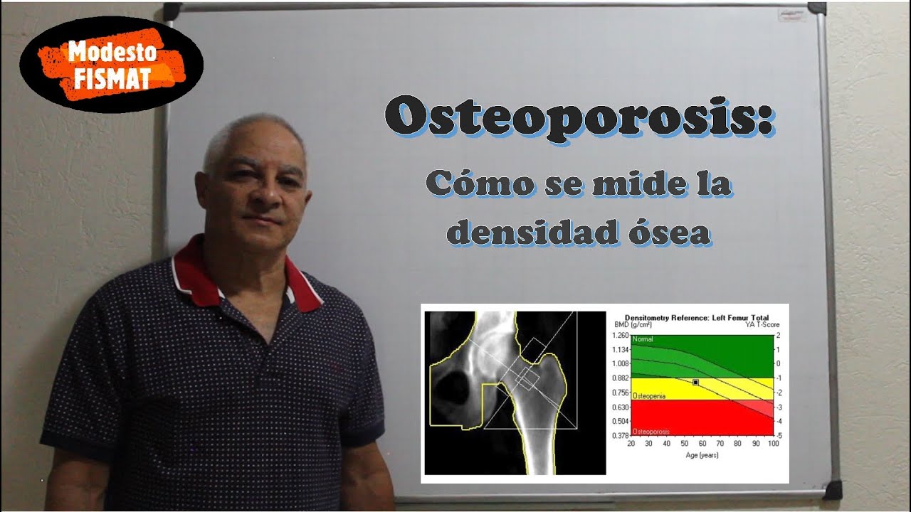 Osteoporosis: Cómo se mide la densidad ósea