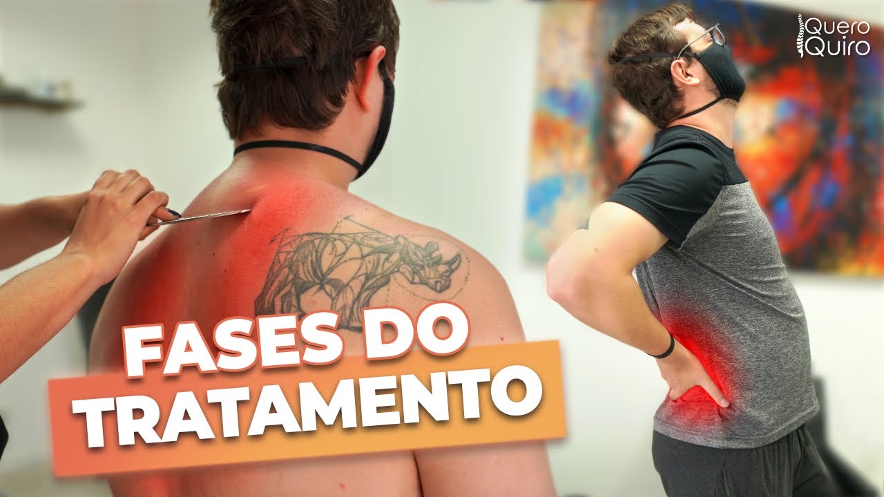 TRATANDO HÉRNIA DE DISCO COM QUIROPRAXIA