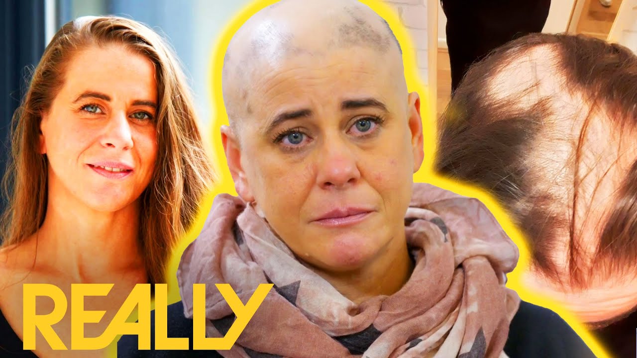 Woman With Alopecia Fears Her Condition May Be Permanent | The Hair Loss Clinic