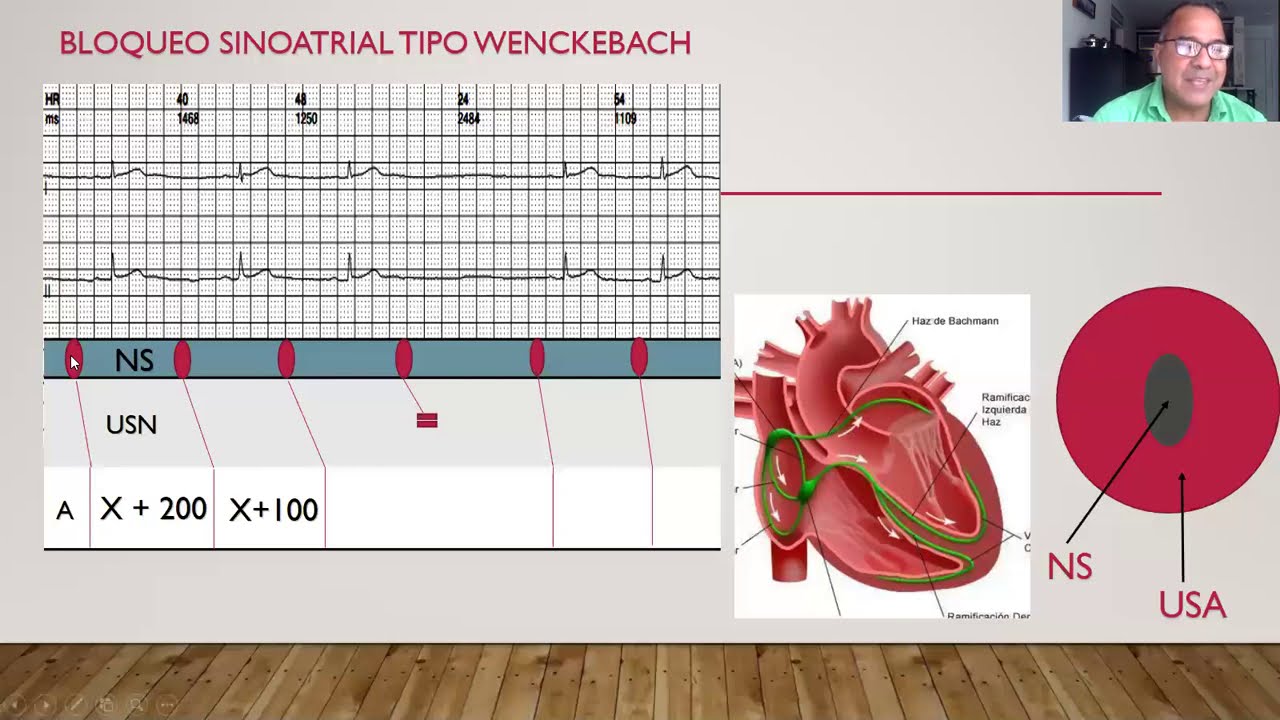 BLoqueo 🆂🅸🅽🅾🅰🆃🆁🅸🅰🅻 tipo Wenckebach. Mecanismo, EKG y Escaleligrama