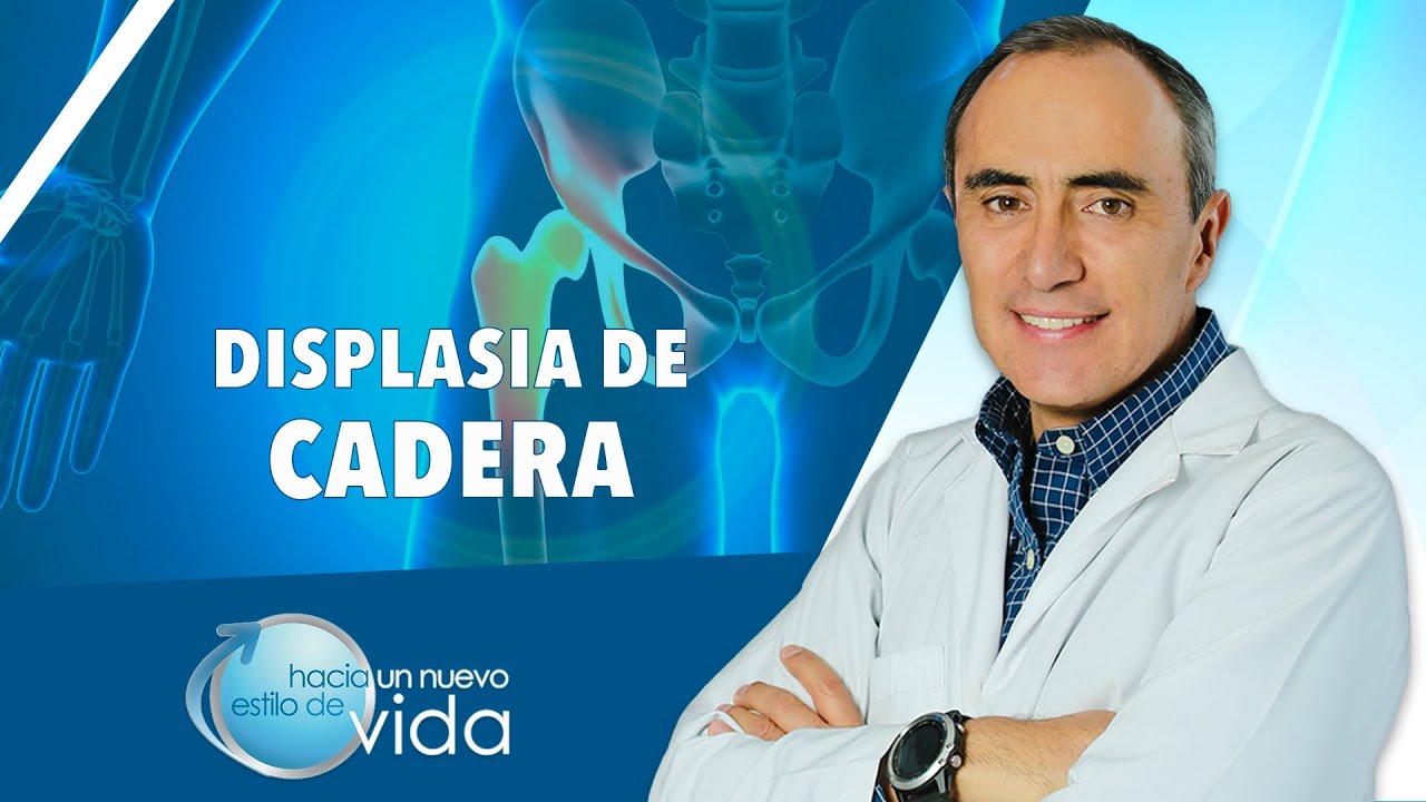DISPLASIA DE CADERA - HACIA UN NUEVO ESTILO DE VIDA