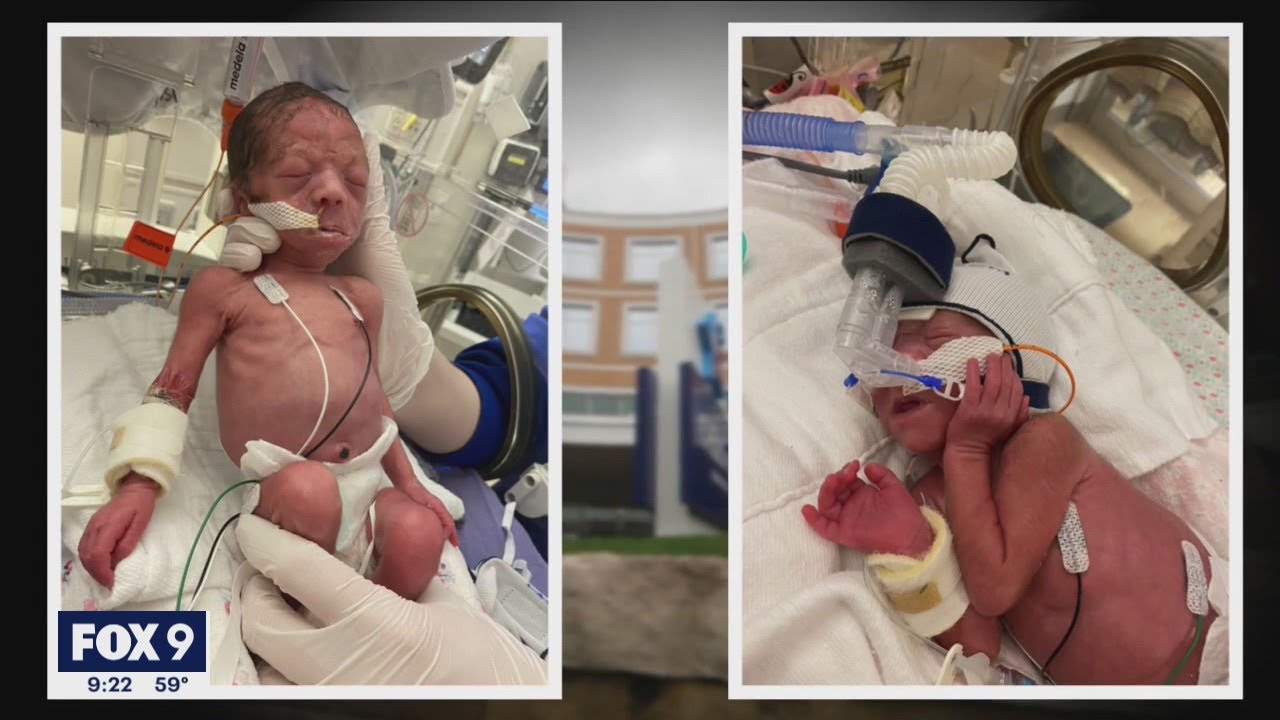 Newborn-mother bonding technique helps NICU baby grow | FOX 9 KMSP