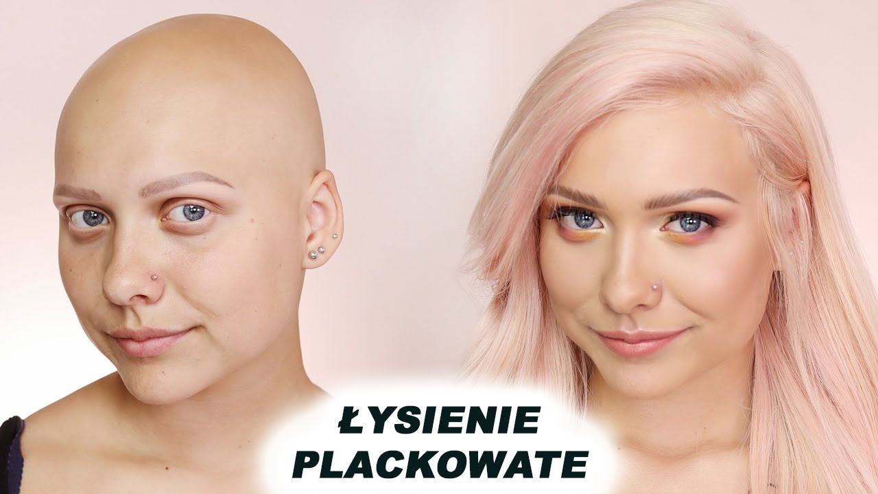 METAMORFOZA KINGI Z ŁYSIENIEM PLACKOWATYM