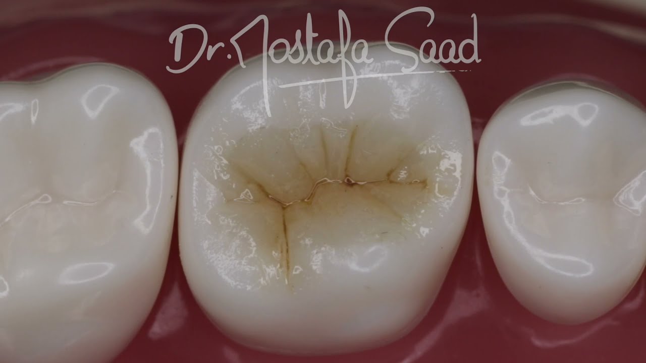 Class I Composite Restoration Upper 6 | How to : Operative Dentistry For Dental Students