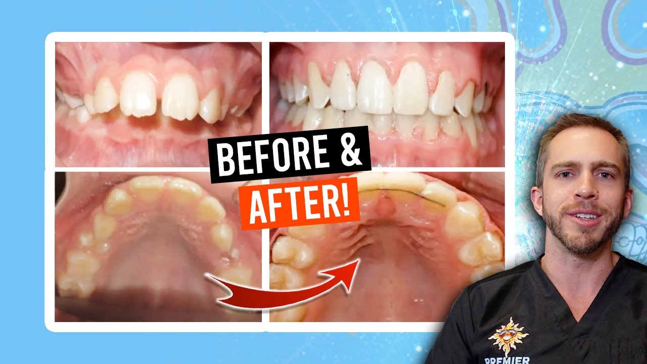 Herbst Appliance & Braces Treatment [BEFORE & AFTER]