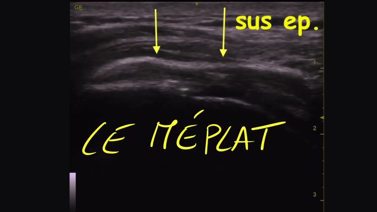 Echo Tuto Epaule 4: le tendon supra épineux normal et pathologique.