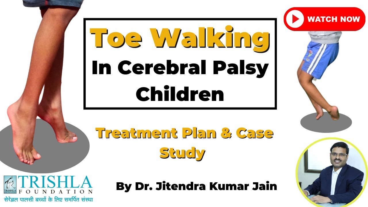 Toe Walking in Early Age Cerebral Palsy Children: Treatment Planning & Case Study: Part 5