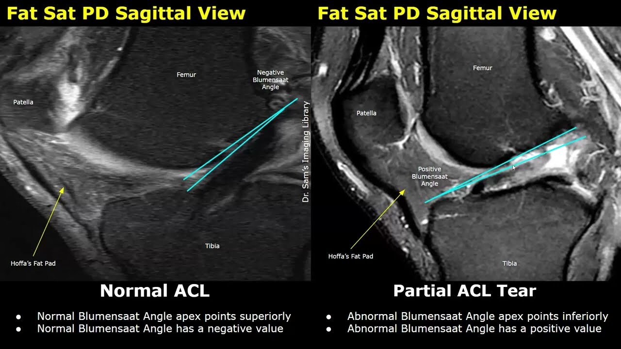MRI Knee Normal Vs ACL Tear | Anterior Cruciate Ligament Tears | Sports Injuries Imaging Cases