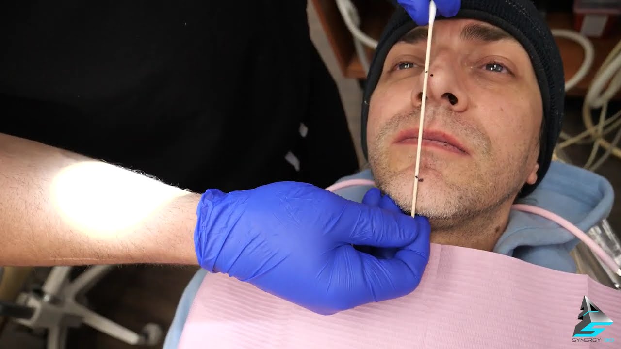 How to scan with Itero for New 3D Printed Complete Denture- Post immediate denture