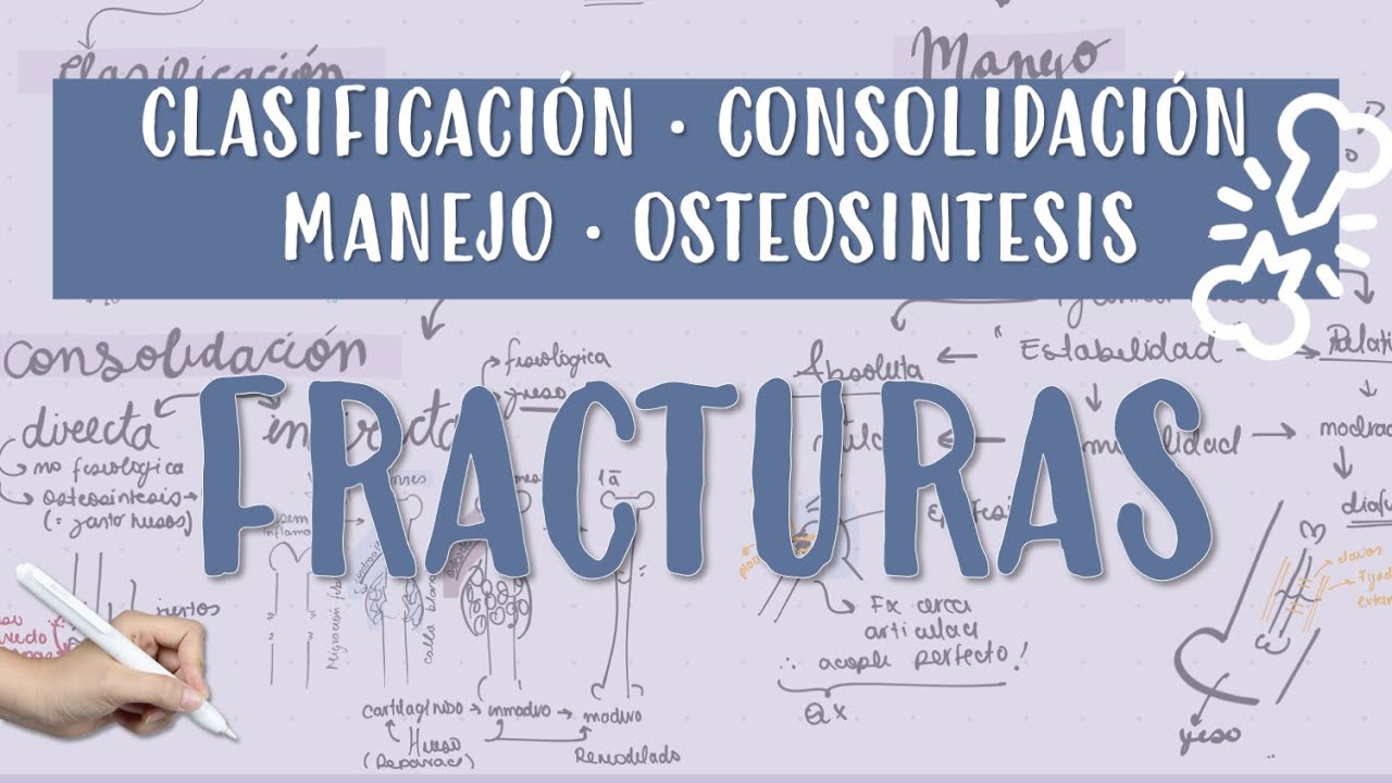 #FRACTURA #CONSOLIDACION #OSTEOSINTESIS #YESO #CALLOBLANDO #CALLODURO