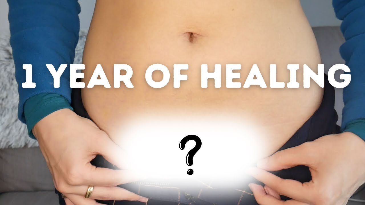 This is what my scar looks like 1 year after C-Section...