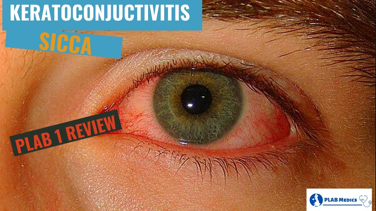 Keratoconjuctivitis Sicca | Dry Eyes - Causes, Symptoms & Treatment (PLAB 1 Ophthalmology Review)