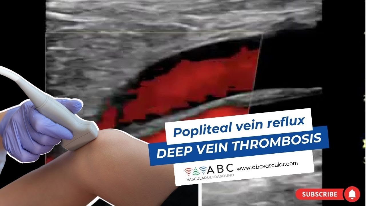 Рефлюкс подколенной вены после тромбоза глубоких вен | УЗИ