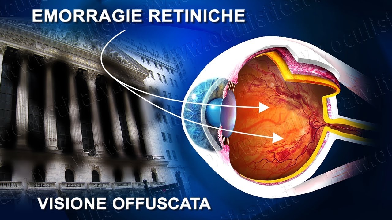 Occlusione vena centrale retinica terapia laser e chirurgica