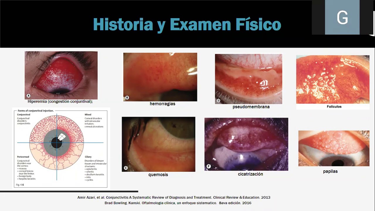 Conjuntivitis Infecciosa - Dr Kenyi Gastelo