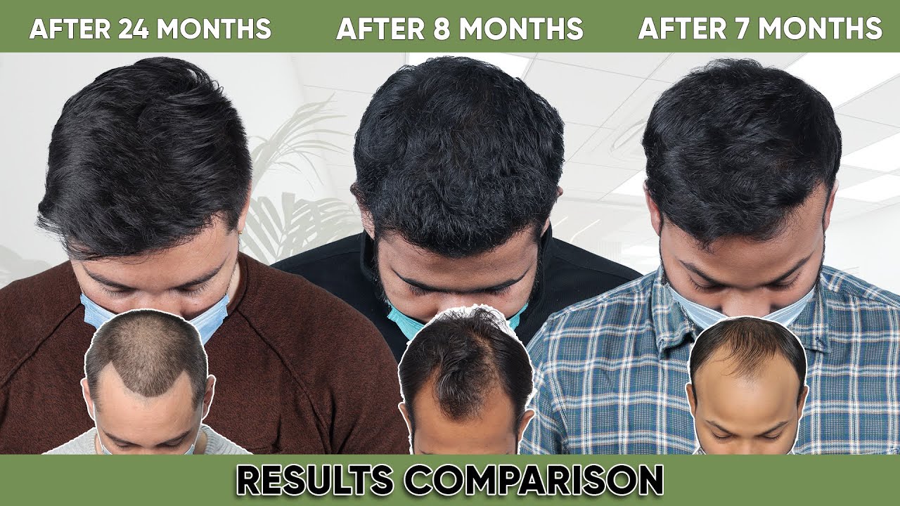 Hair Transplant in Bangalore  (HX-QWCS)  | Best Results & Cost of Hair Transplant in  Bangalore.