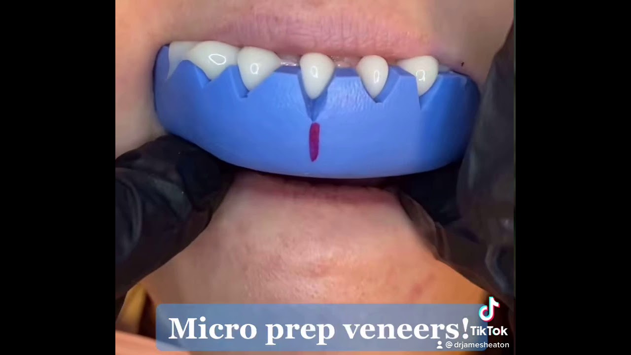 Temporary Veneers