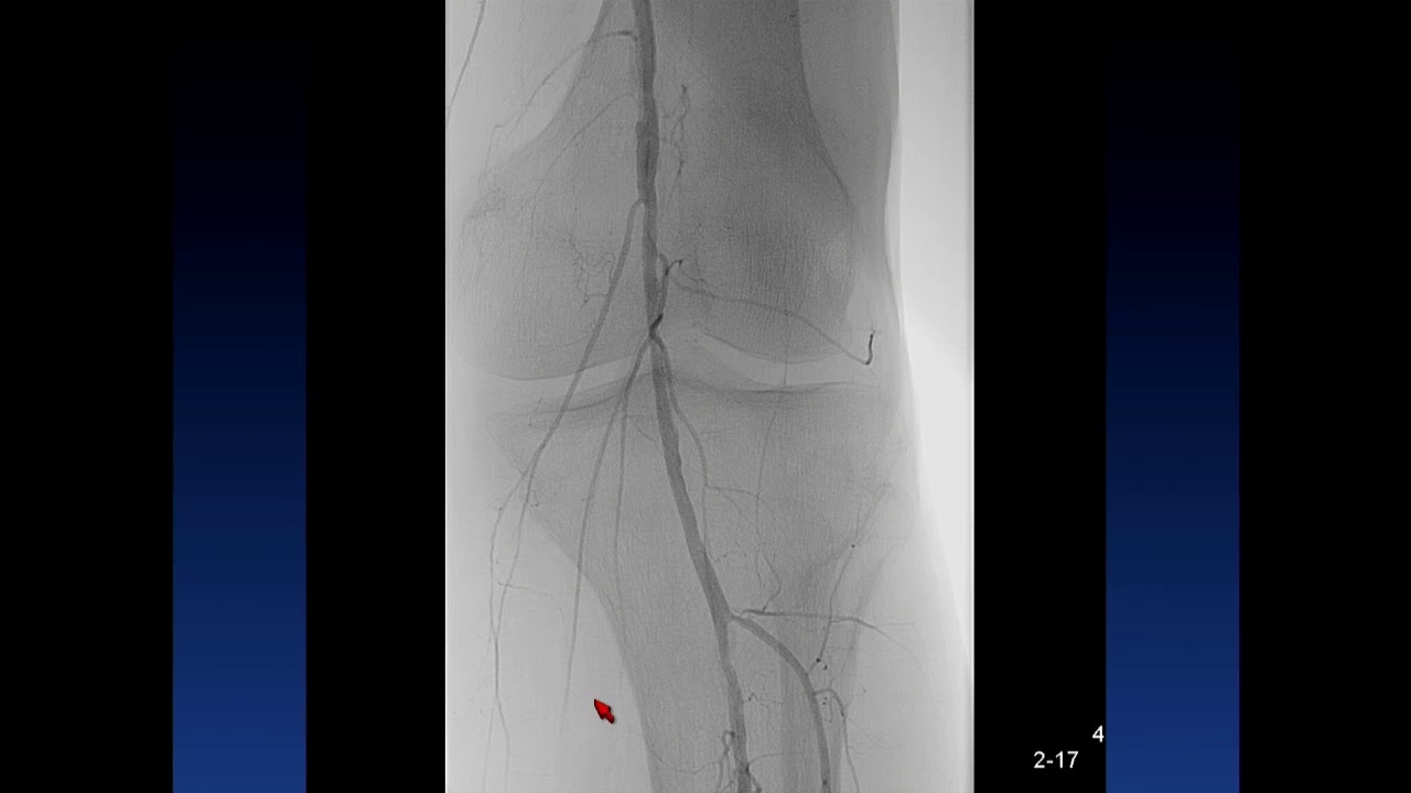 Retrograde SFA, Popliteal, and via Stent - Ehrin Armstrong, MD