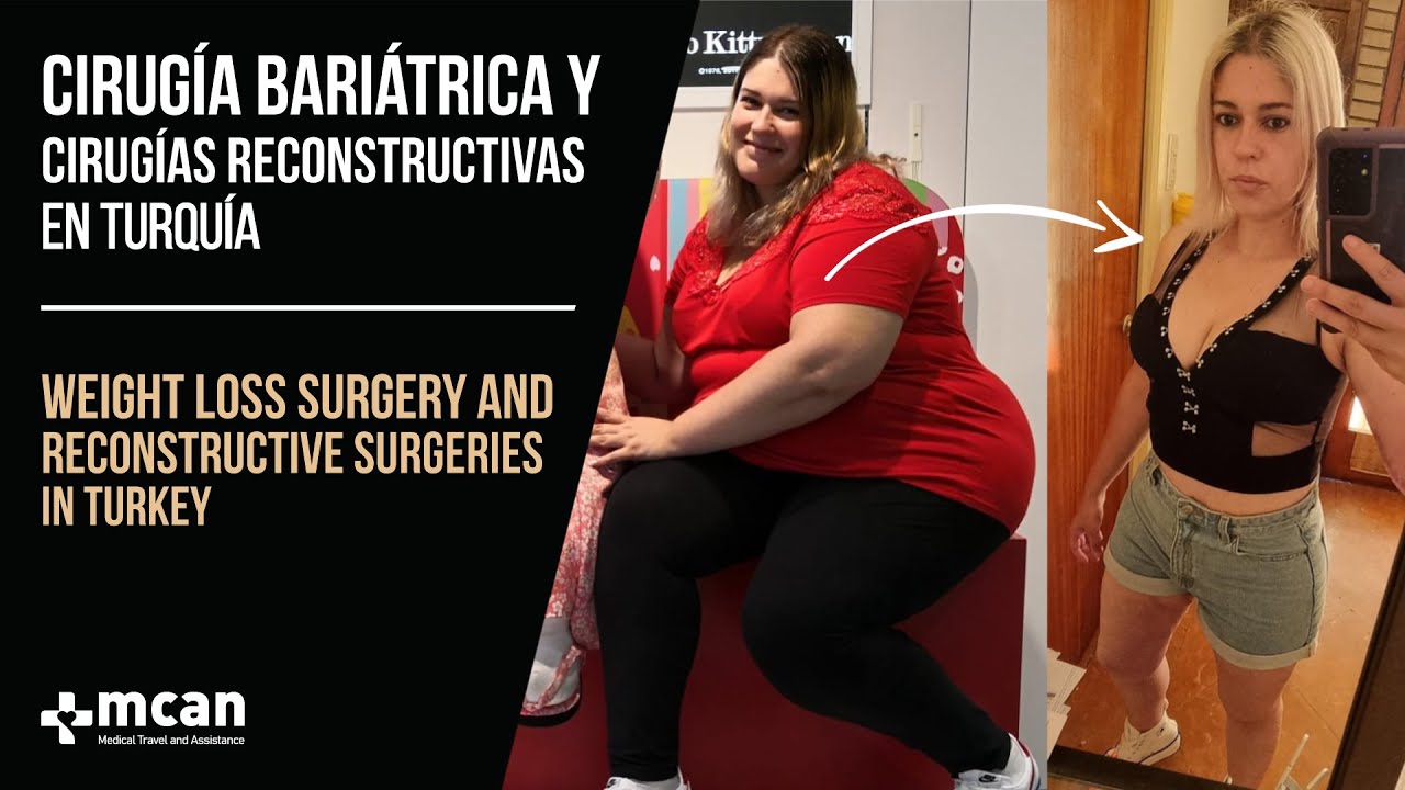 Todo sobre la cirugía bariátrica y cirugías reconstructivas de Nuria con fotos de antes y despues! 😱