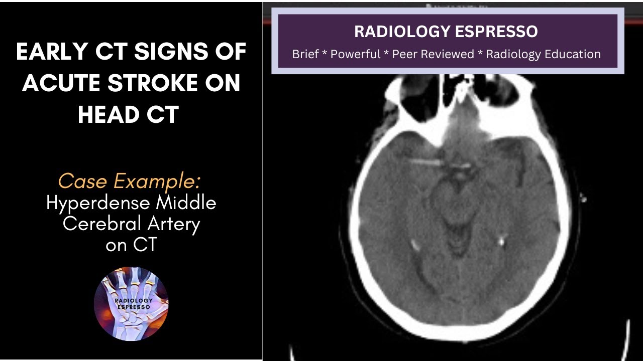 EARLY CT SIGNS OF ACUTE STROKE ON HEAD CT: Case Example - Hyperdense Middle Cerebral Artery (9220)