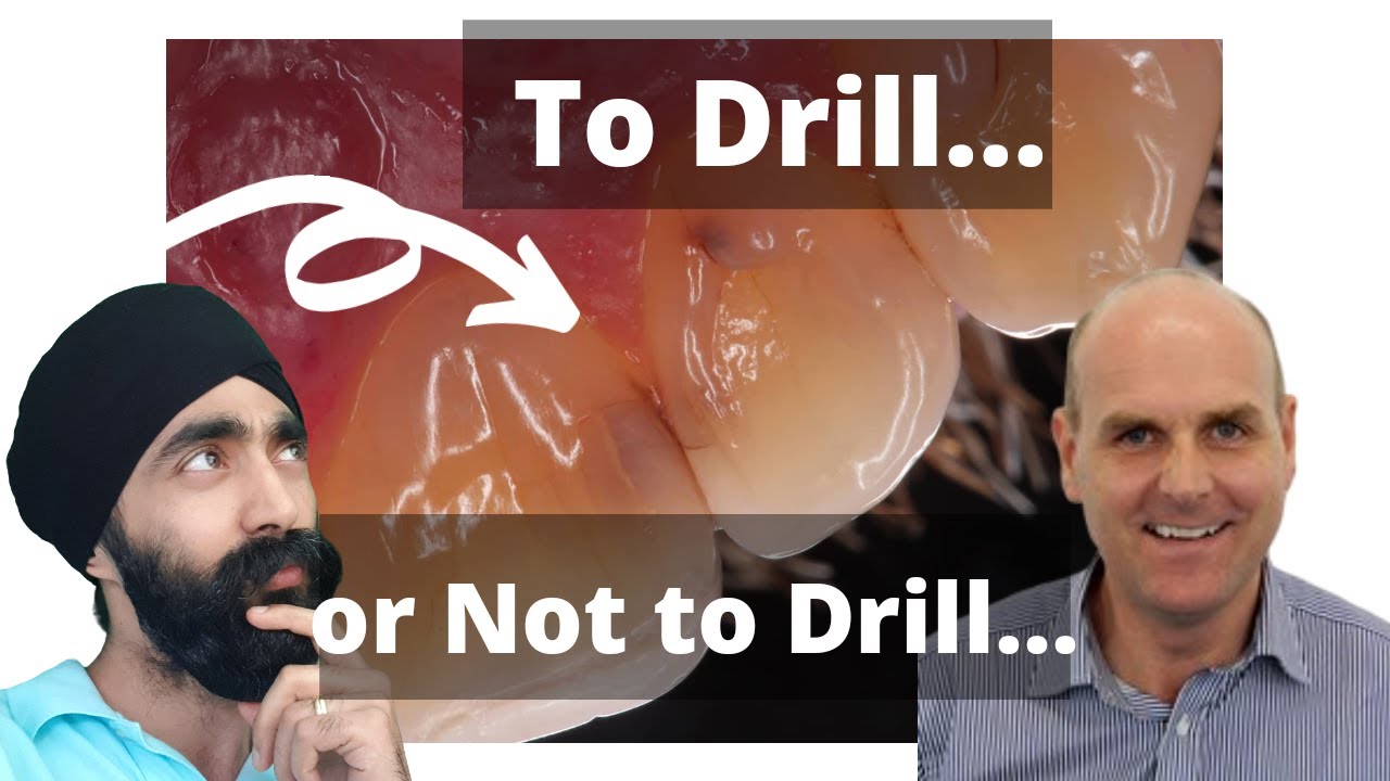 [The Caries Debate] To Drill or Not to Drill with Dr Louis McKenzie