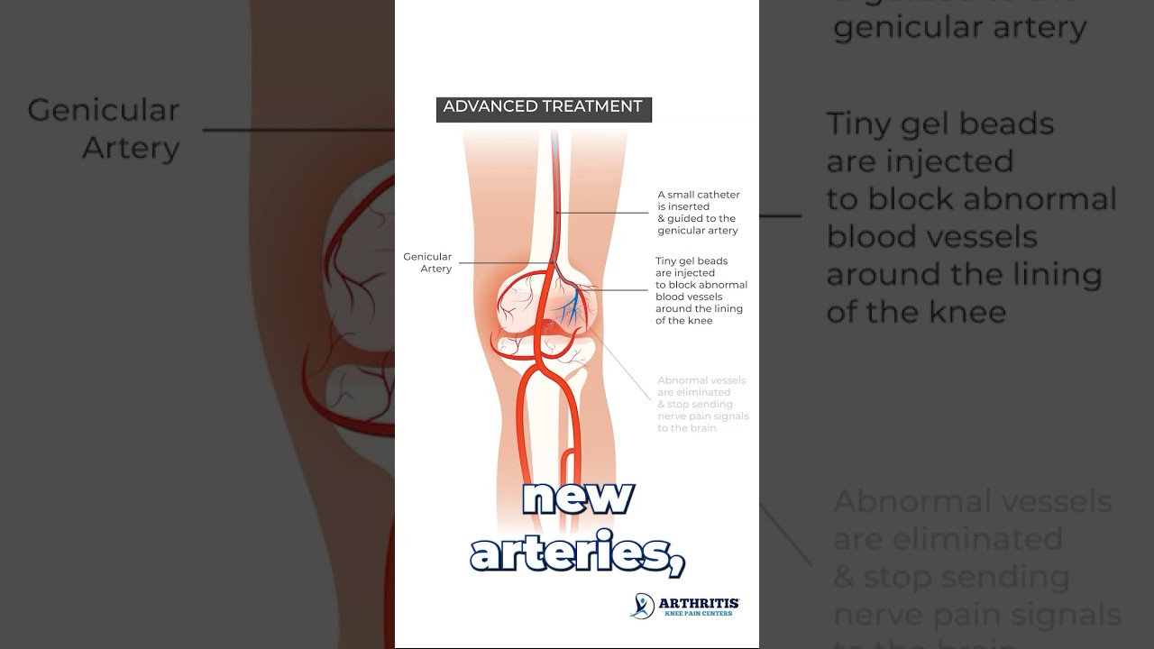 Have you heard of Genicular Artery Embolization? If not&hellip;