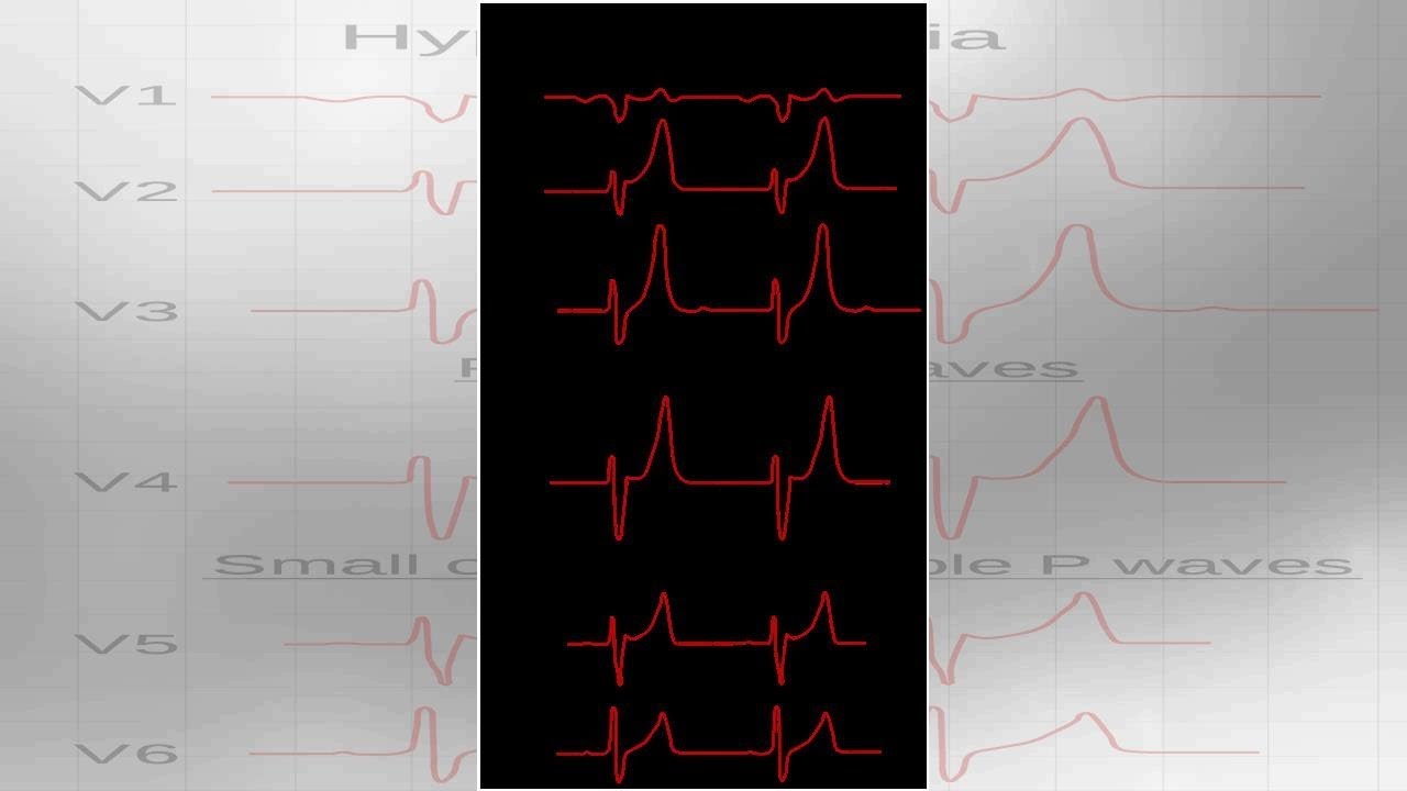 Hiperkaliemia