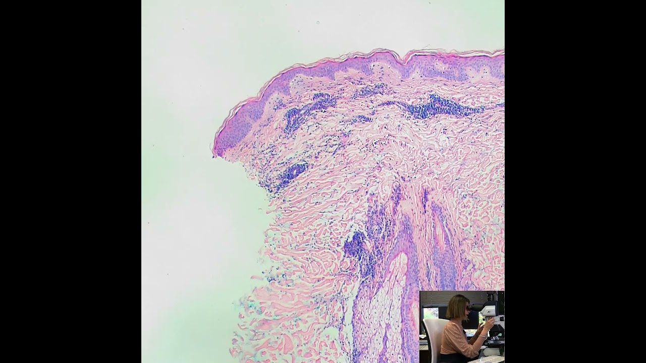 Tumid Lupus Erythematosus discussion with Dr. Anand