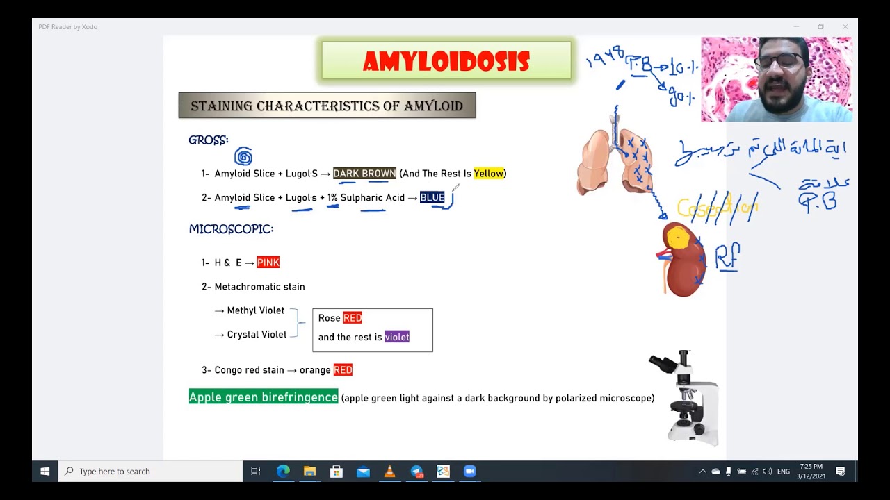 AMYLOIDOSIS - طب بشرى الفرقه الاولى القصر العينى